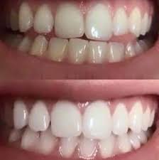 Snowhite Teeth Whitening – sastav – test- sastojci